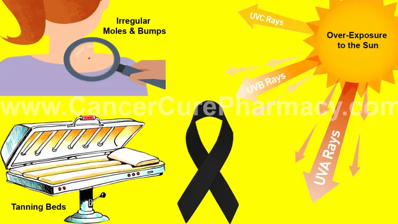 Does Exposure from the Sun cause Melanoma Skin Cancer