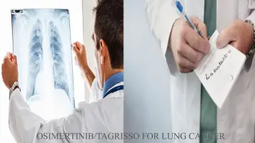 How Tagrisso Osimertinib medication can treat your lung cancer