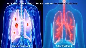 Erlotinib Tarceva Dosage Uses Side Effects and Treatment Medication