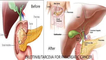 The Connection Between Erlotinib Tarceva and Pancreatic Cancer