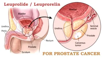 Is Lupron Depot effective in the treatment of Prostate Cancer