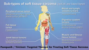 Pazopanib Votrient Targeted Therapy for Treating Soft Tissue Sarcoma