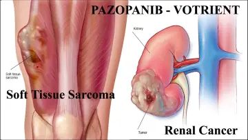 Votrient Treatment for Renal Cell Cancer and Soft Tissue Sarcoma