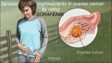 Survival Improvements in Ovarian Cancer by using Sorafenib