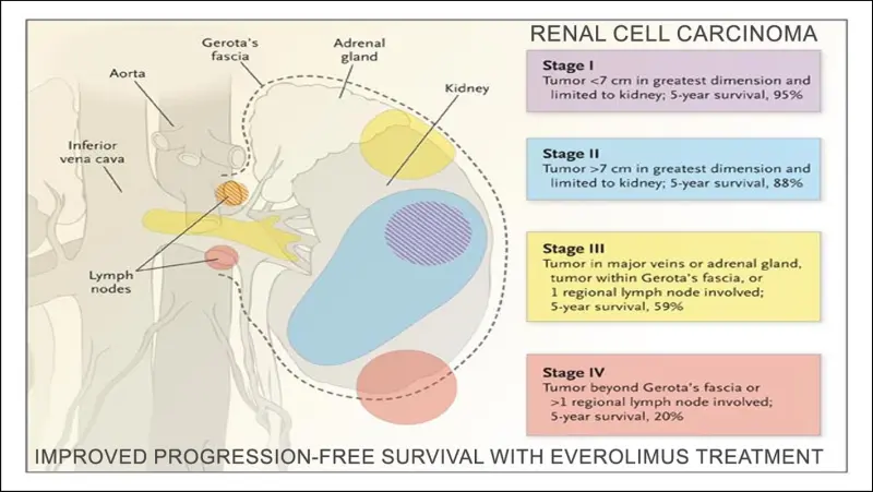 Improved Progression Free Survival in Renal Cell Cancer with Everolimus Treatment