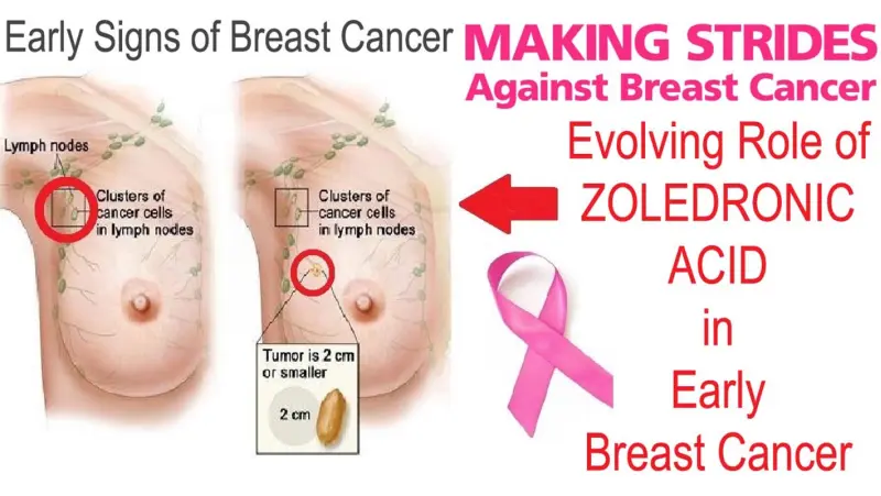 Evolving role of zoledronic acid in early breast cancer