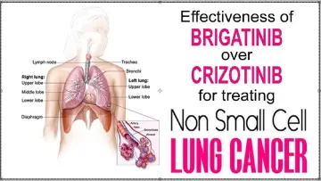 The Effectiveness of Brigatinib over Crizotinib for Treating Non Small Cell Lung Cancer