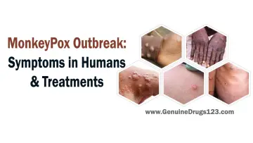 Monkeypox outbreak symptoms in humans treatments
